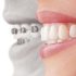 Invisalign: riprendiamoci il sorriso